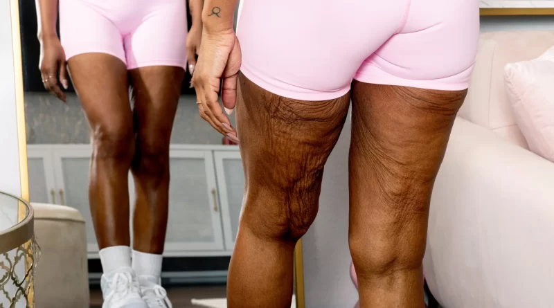 उन्होंने मोटापा तो कम कर लिया, लेकिन त्वचा का क्या?