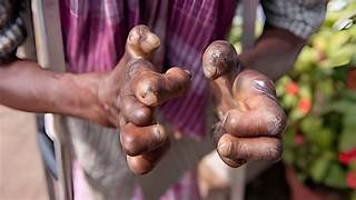 LEPROSY IN INDIA: THE ROAD TO A DISEASE-FREE FUTURE