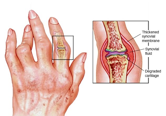 खराब हवा से बढ़ रहा रूमेटाइड आर्थराइटिस का खतरा