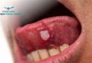 Scientists pave way for potential new therapy for tongue cancer