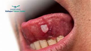 Scientists pave way for potential new therapy for tongue cancer
