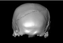 A 14th-Century Skeleton Had Injuries That Looked Like a Car Crash. What Killed Him?